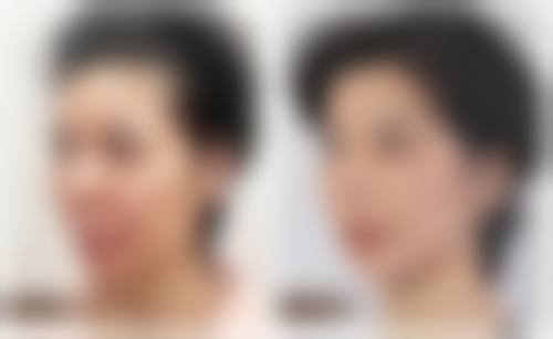 沈阳美莱医疗美容医院做完假体隆胸多久开始运动适合吗？