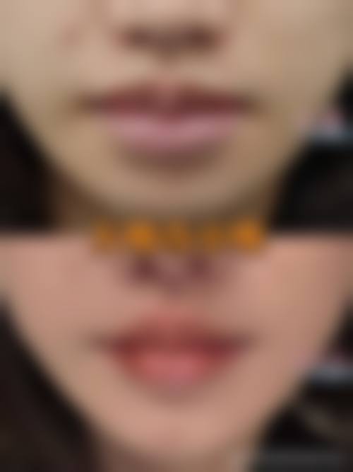 扬州艾菲斯整形真实实例：美丽蜕变看得见