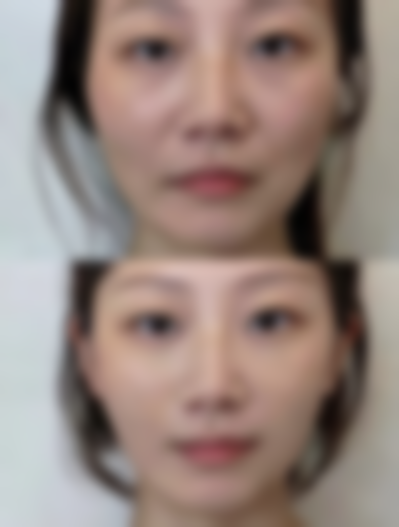 怎样去除增生性疤痕好？揭秘医美 5 大有效方法，让你告别凹凸疤痕重拾光滑肌肤，你还不试试？