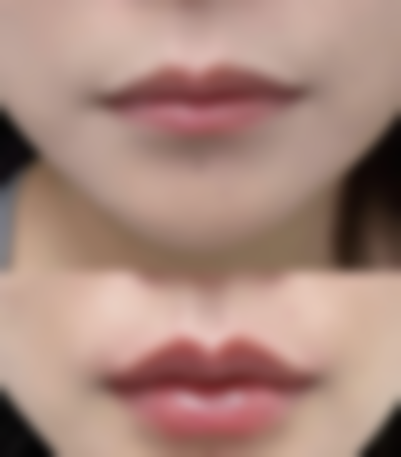 北京嘉禾医疗美容改善双眼皮变三眼皮靠谱吗？