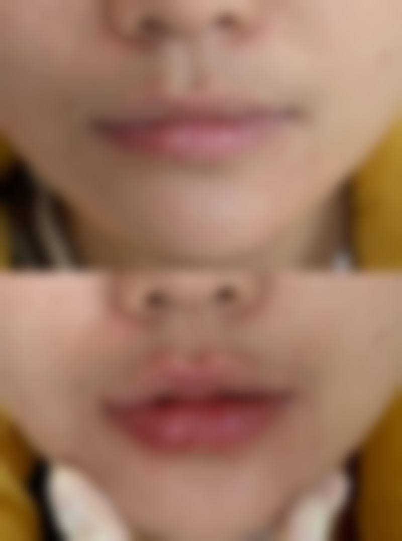 北京丽合医疗美容医院去除增生性疤痕适合吗?