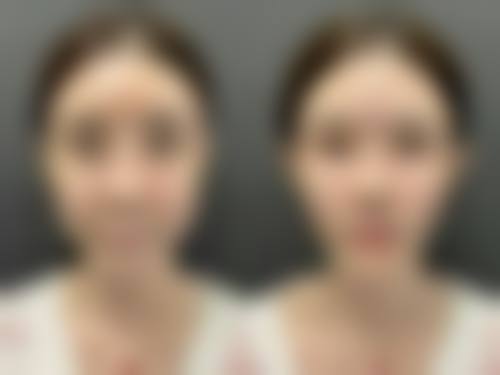 打完除皱多久能化妆？揭秘3大关键时间节点与化妆注意事项，让你美出新高度！ 