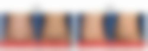 怎么去除烧伤后的疤痕？揭秘医美界3大有效祛疤方法，让你告别疤痕困扰重焕自信光彩！ 