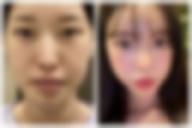 沈阳美莱医疗美容医院去眼袋适合吗？