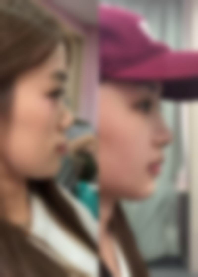 如何去除脸上的眼袋？揭秘医美界3大热门去眼袋方法，安全高效还你紧致双眸，你还在等什么？ 