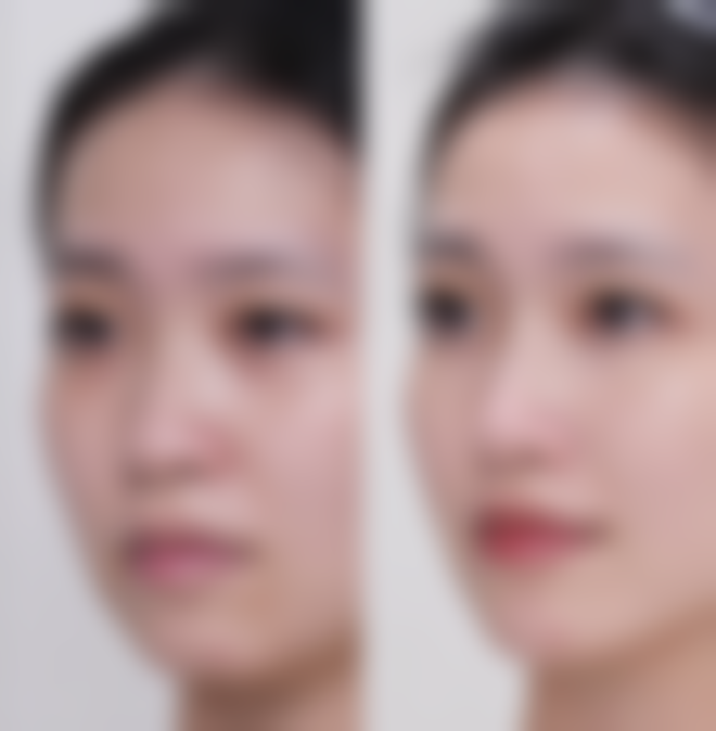 沈阳美莱医疗美容医院割双眼皮后下垂问题怎么应对？