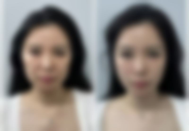 沈阳元辰医疗美容门诊部去眼袋技术如何？