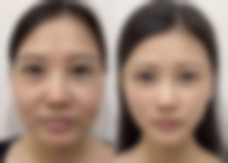 沈阳名流美容医院去除烧伤疤痕怎么样？