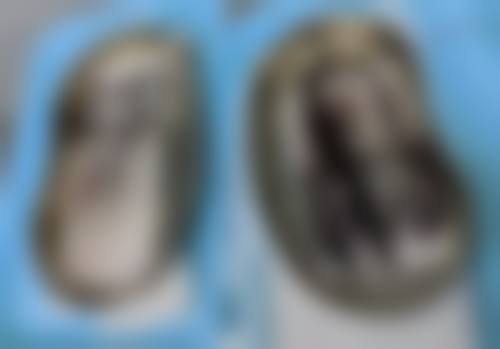 去疤膏可以完全去掉疤痕吗？揭秘3种常见疤痕适用的去疤膏，让你不再为疤痕问题愁眉苦脸！ 