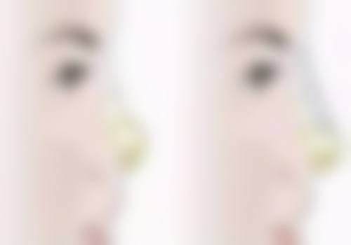 沈阳杏林整形外科医院做埋线双眼皮维持时间怎么样？