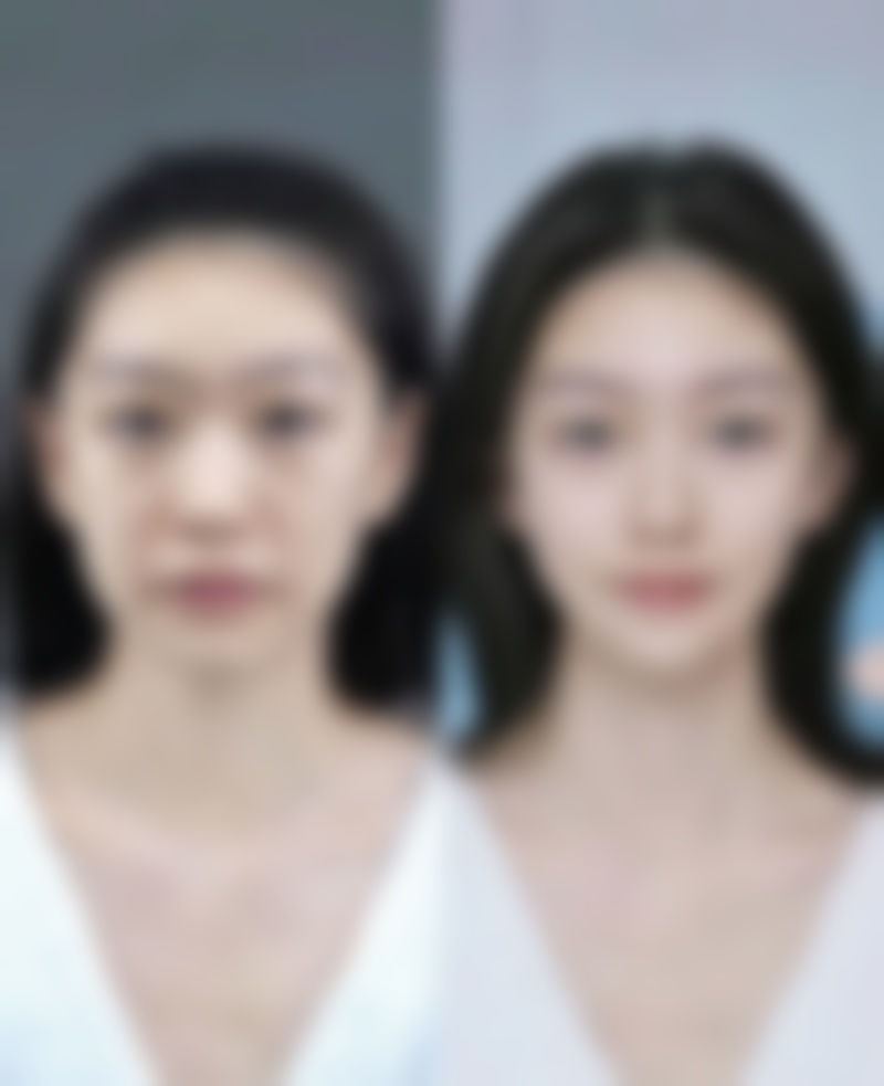 福清东南眼科医院祛眼袋值不值