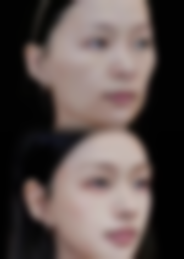 画美医疗美容改善双眼皮特别松怎么样？