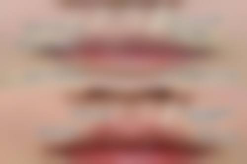 慕兰海微晶贴适合哪些人去眼袋？