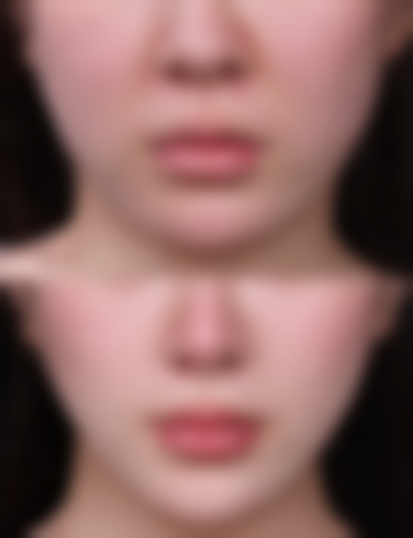 沈阳名流美容医院去除女人眼袋适合吗？