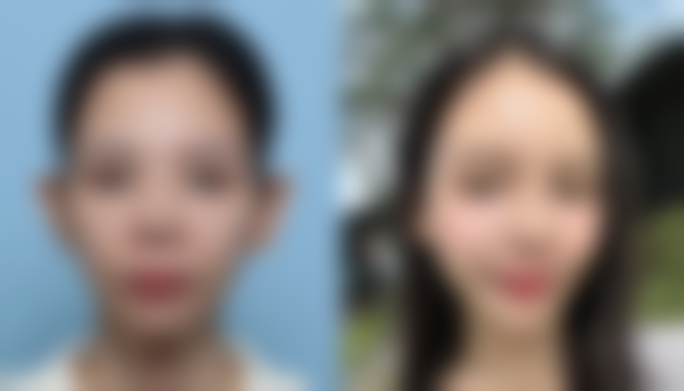 很深的眼袋该如何去除？揭秘3大医美妙招，快速告别熊猫眼，还你紧致年轻双眸！ 