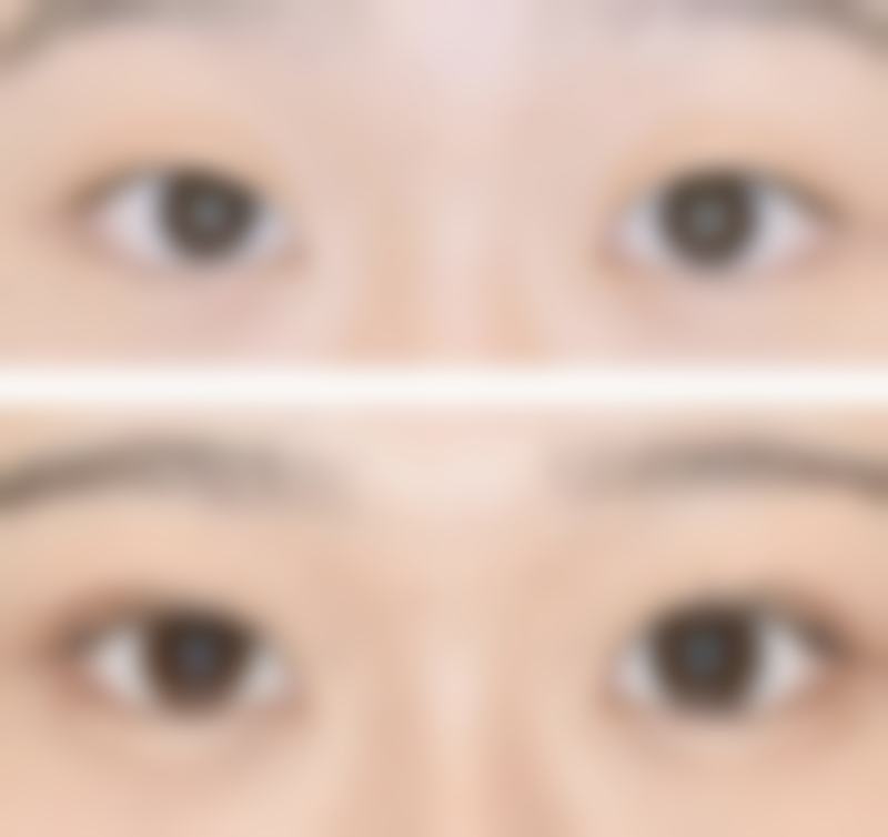 手术祛眼袋后成效能维持多久