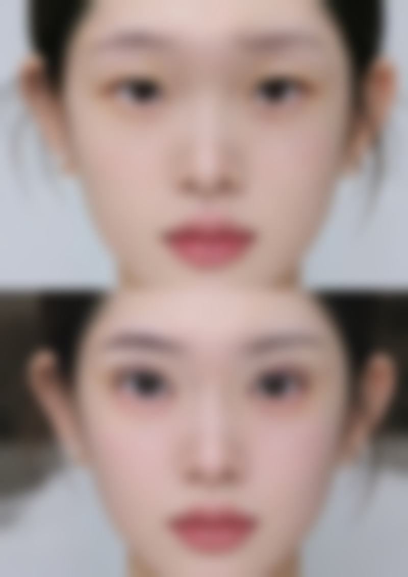 沈阳杏林整形外科医院消除女人眼袋成效好吗？