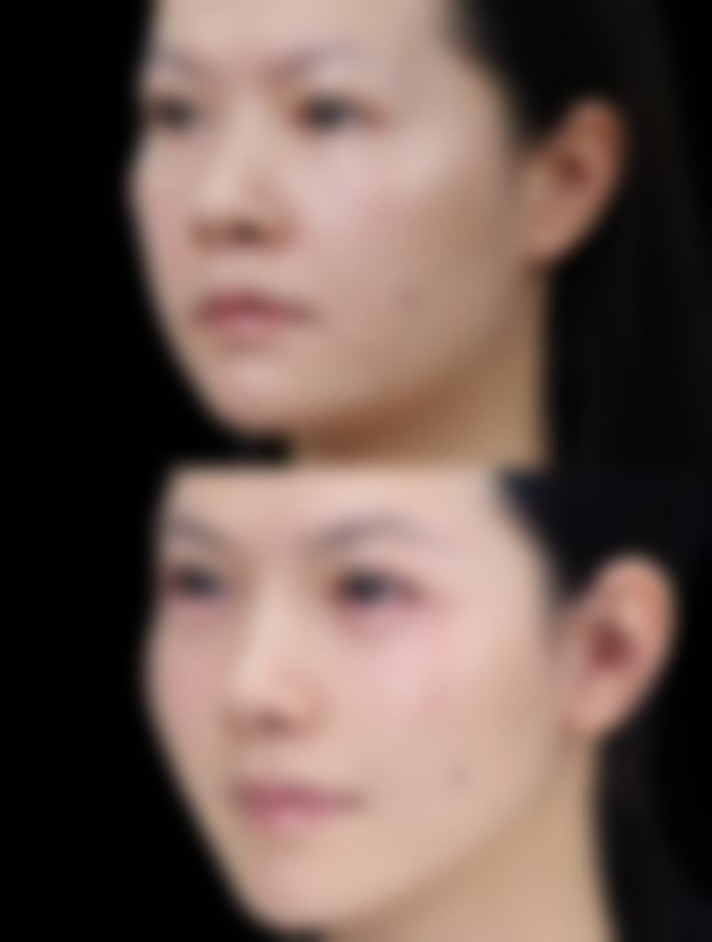 北京嘉禾医疗美容去女人眼袋怎么样？