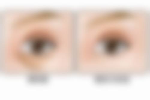 硅胶隆胸20年不取出，参考医院评估结果做决策靠谱吗