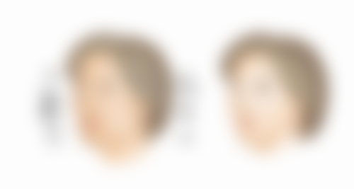 自体脂肪隆胸变软受哪些因素影响，北京这些医院做得如何？