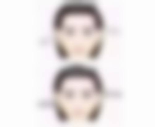 沈阳杏林整形割眼袋术后多久用疤痕贴？