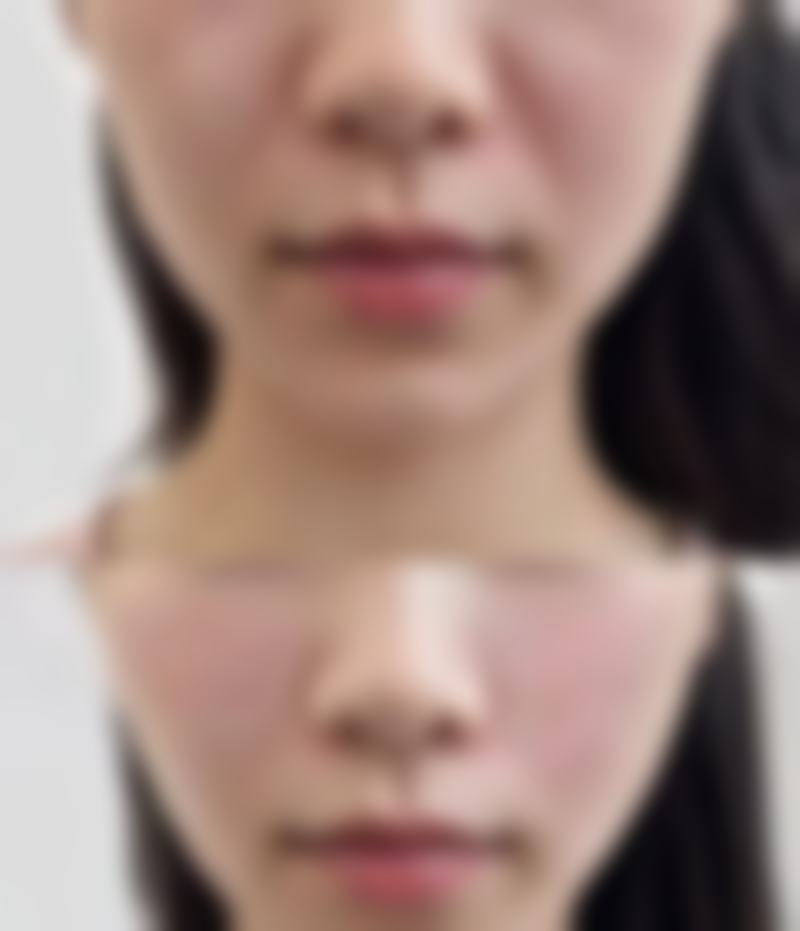 硅胶隆胸20年不取出 会有什么后果？了解潜在风险，4大安全评估要点助你理性判断是否继续留植！ 