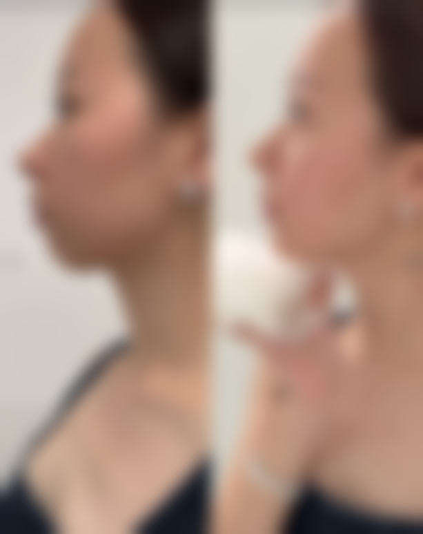 杨中举医生真实实例：见证美丽蜕变时刻