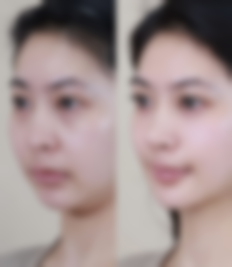 沈阳元辰医疗美容门诊部打瘦脸针有保护吗？