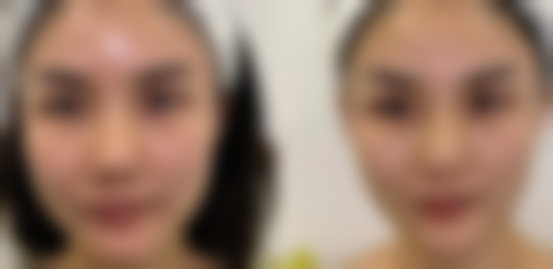 北京圣嘉新医疗美容医院自体脂肪隆胸变软靠谱吗？