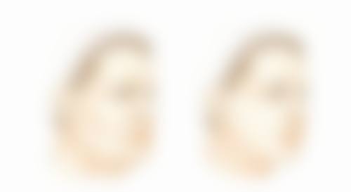 北京嘉禾医疗美容去眼袋怎么样？