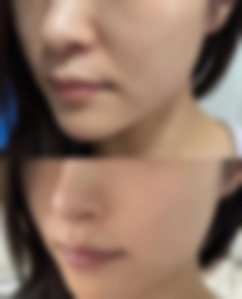 做全切双眼皮手术需要多长时间？揭秘20 - 60分钟手术时长背后影响因素，让你安心变美！ 