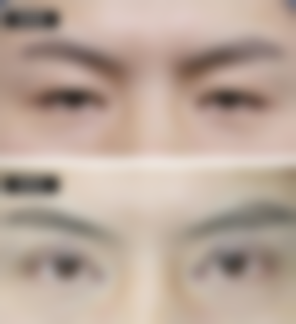 北京禾美嘉医疗美容做假体隆胸适合吗，风险高吗？