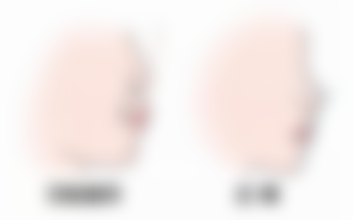 西安画美医疗美容医院隆胸后生孩子喂奶值不值？