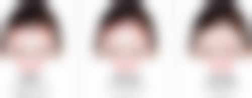 20岁有眼袋选择医美治疗风险大吗？