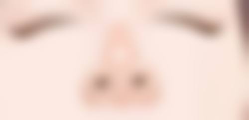 双眼皮术后疤痕增生3个月后减轻的秘诀有哪些？