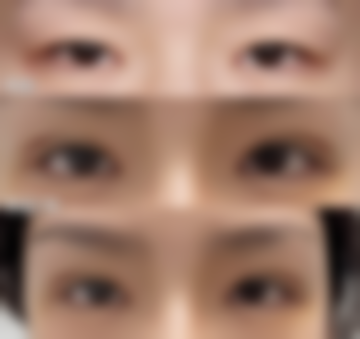 下眼袋上的脂肪粒怎么办？揭秘3种医美消除法，快速有效还安全，你知道是哪几种吗？ 