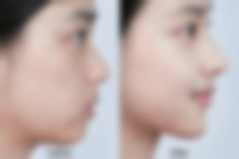 非常爱美网推荐的机构补充胶原蛋白去眼袋值不值