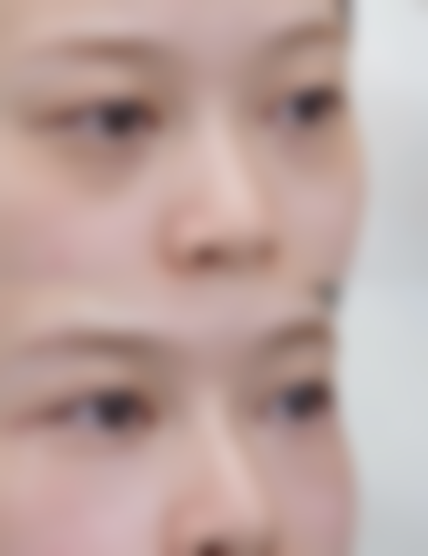 三点定位双眼皮的费用值不值？