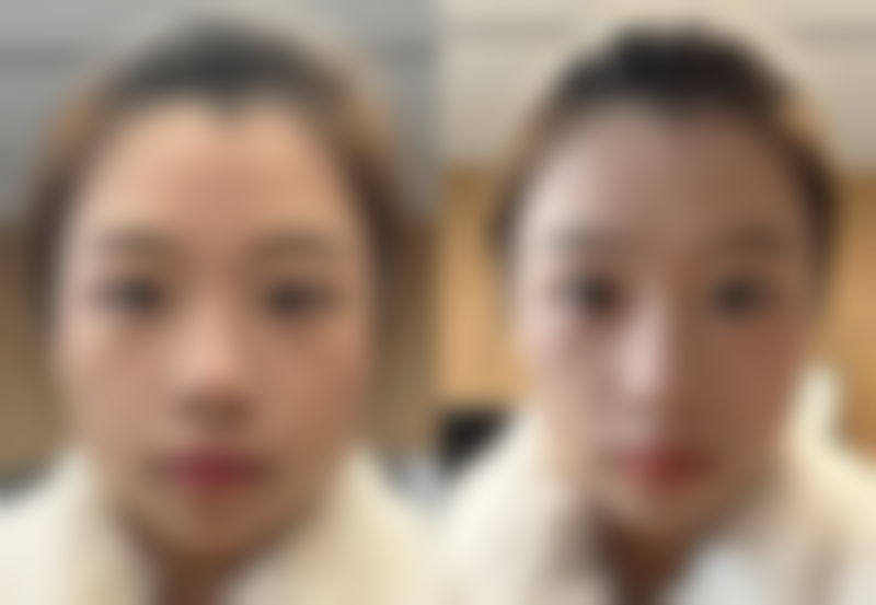 北京嘉禾医疗美容补充胶原蛋白去眼袋靠谱吗