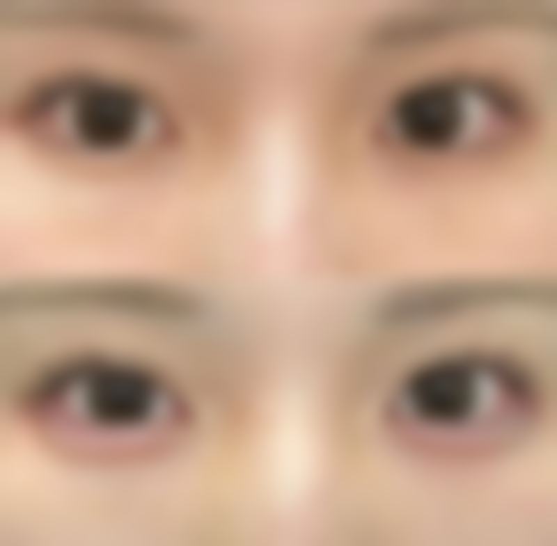 沈阳杏林整形祛疤需要多长时间能修复好？