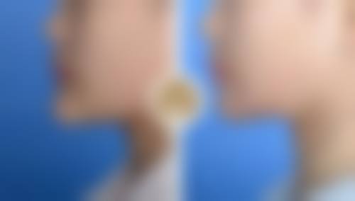 韩国 barog 医院江南店切除疤痕增生后复发率高吗？