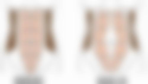 呼和浩特京美医疗美容医院臀部抽脂值不值？