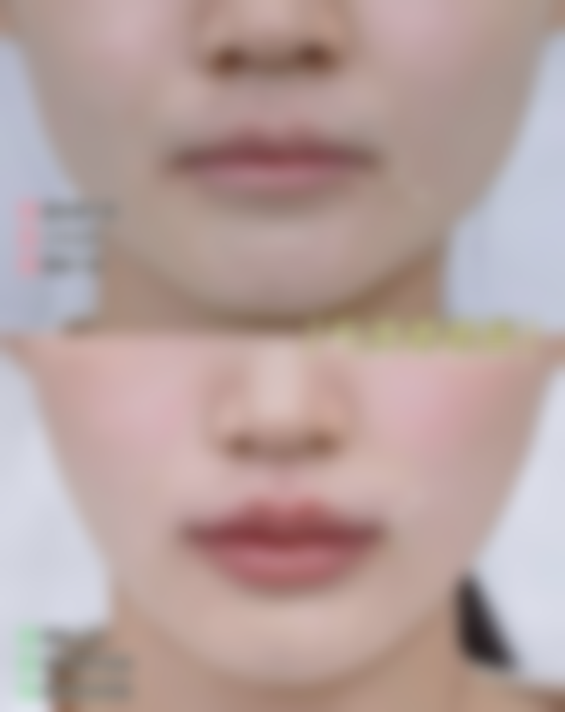 膨体假体隆胸适合乳腺癌术后重建患者吗