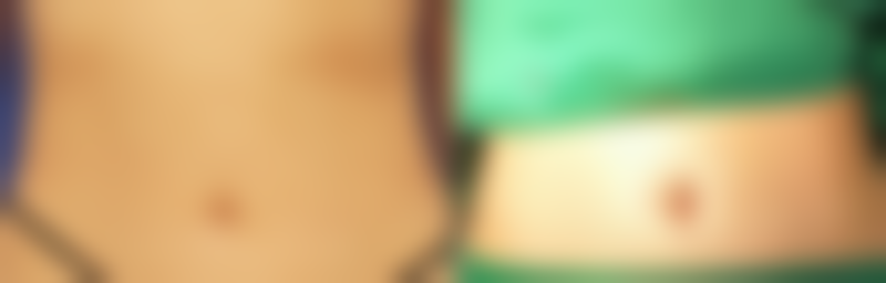 西安莲湖西交疤痕医院切除疤痕增生后增生的几率大吗？