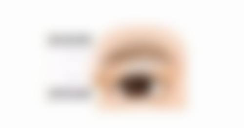 北京嘉禾医疗美容做双眼皮后遗症靠谱吗