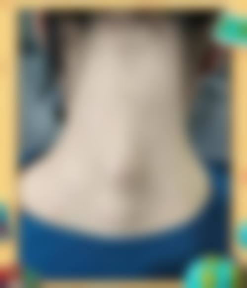 东莞伊嘉整形医院真实实例