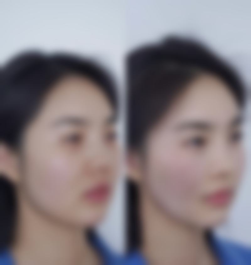 北京加减美医疗美容医院注射隆鼻值不值？