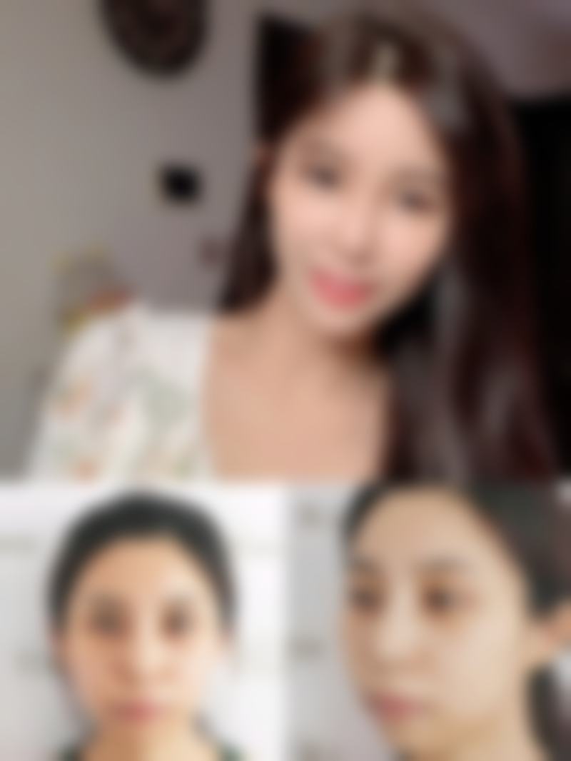 呼和浩特京美医疗美容医院做双眼皮后遗症怎么样