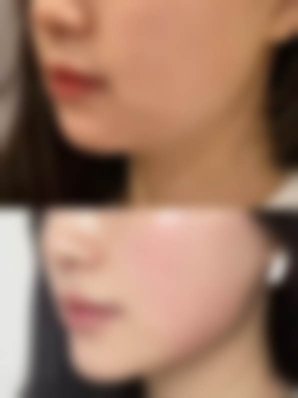 北京画美医疗美容的手术隆胸适合我吗