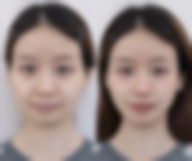 北京画美医疗美容解决腿部抽脂凹凸不平有成效吗？